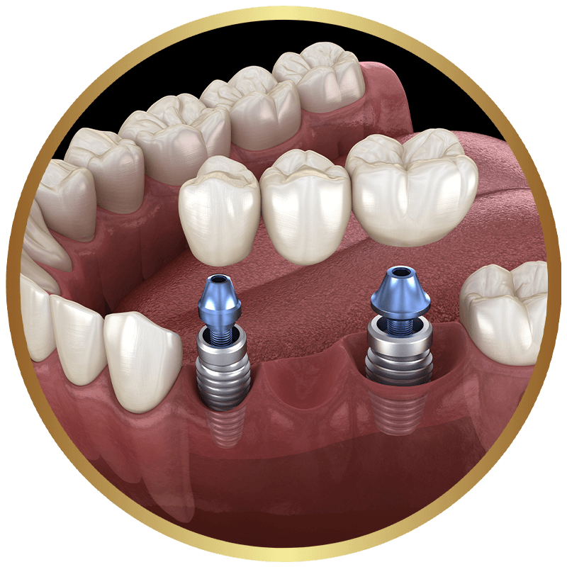 Rendering of an implant-supported dental bridge
