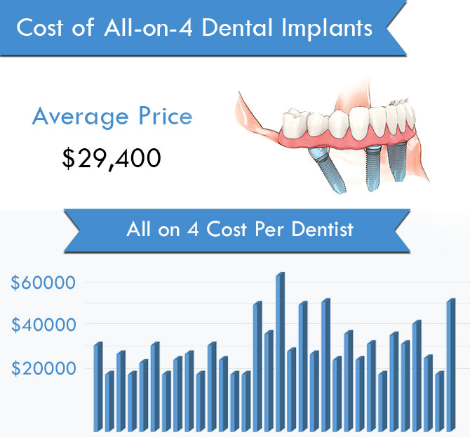 Cost of All on 4 Dental Implants in Southern California