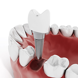 dental_implants_06232016_thumb
