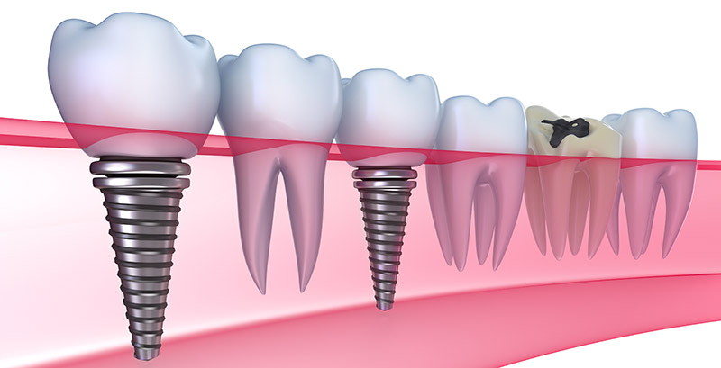 dental_implants_0915