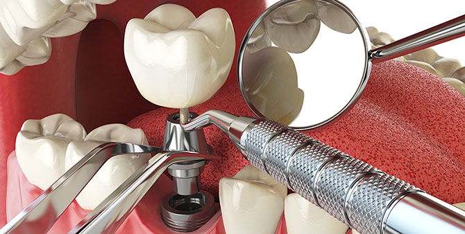 dental_implants_close