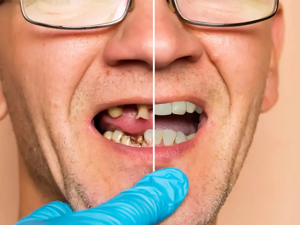 Signs You Need a Dental Implant
