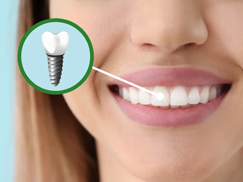 Give Yourself Something to Smile About with Dental Implants