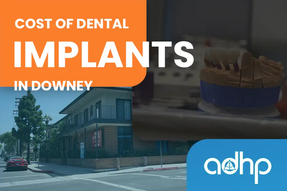 Cost of Dental Implants in Downey