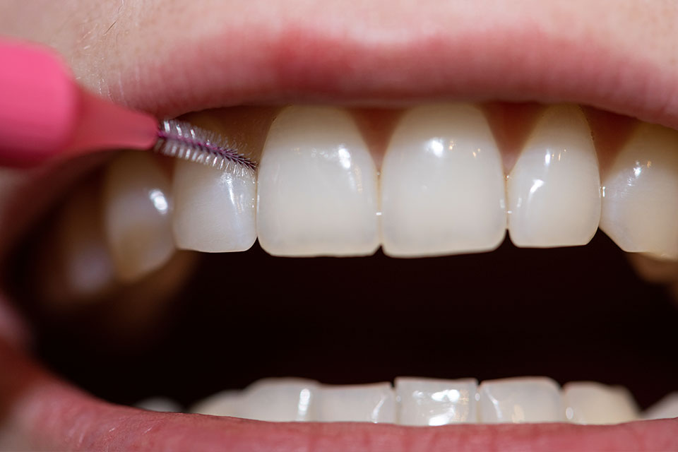Interdental brush for dental implant maintenance