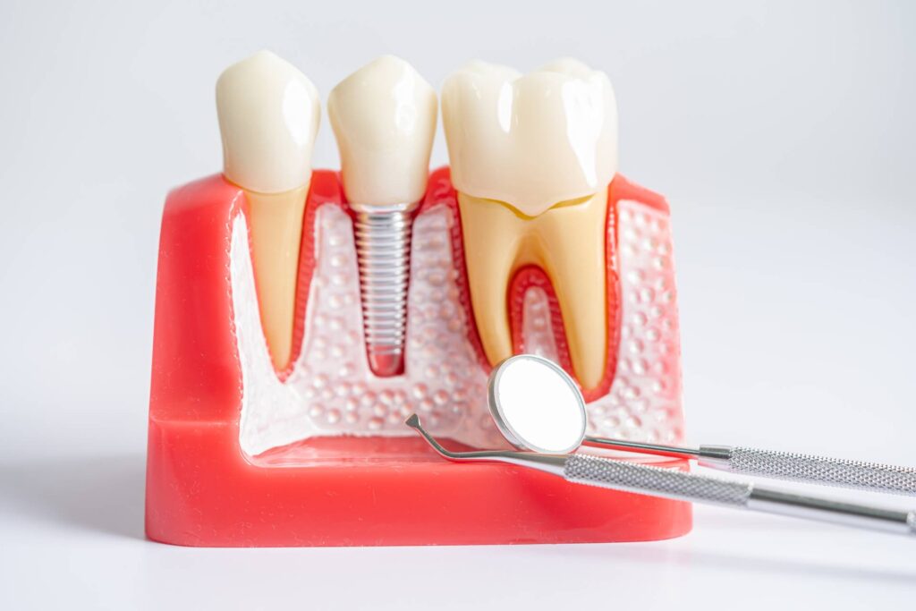 fallbrook affordable dental health providers How Long Do Implants Last?