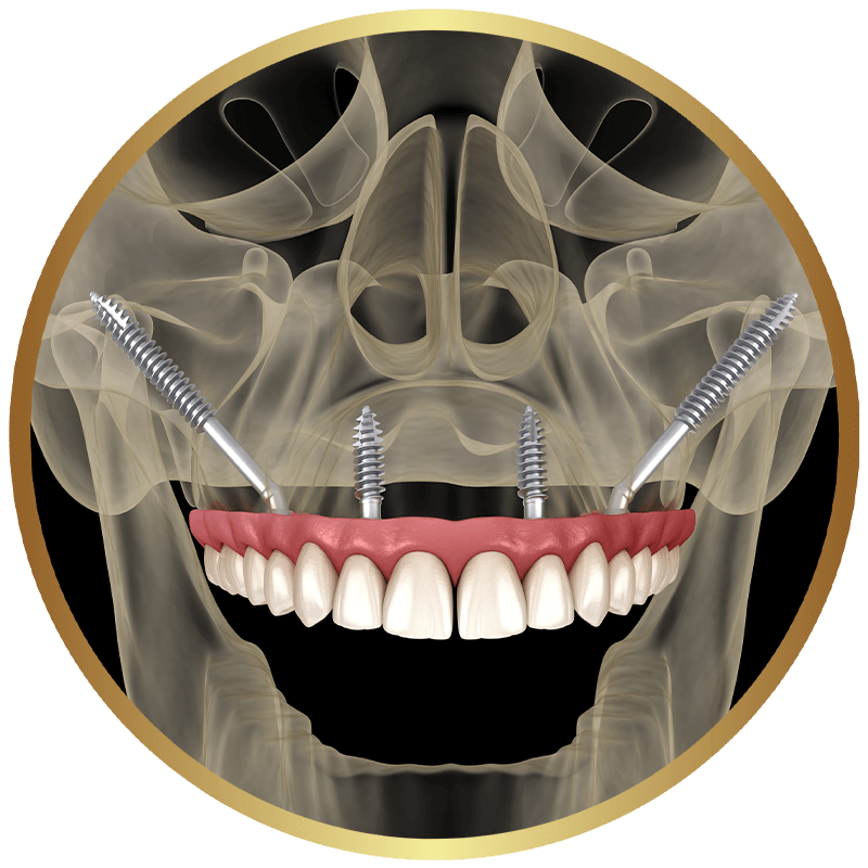 zygomatic implant 3d gold
