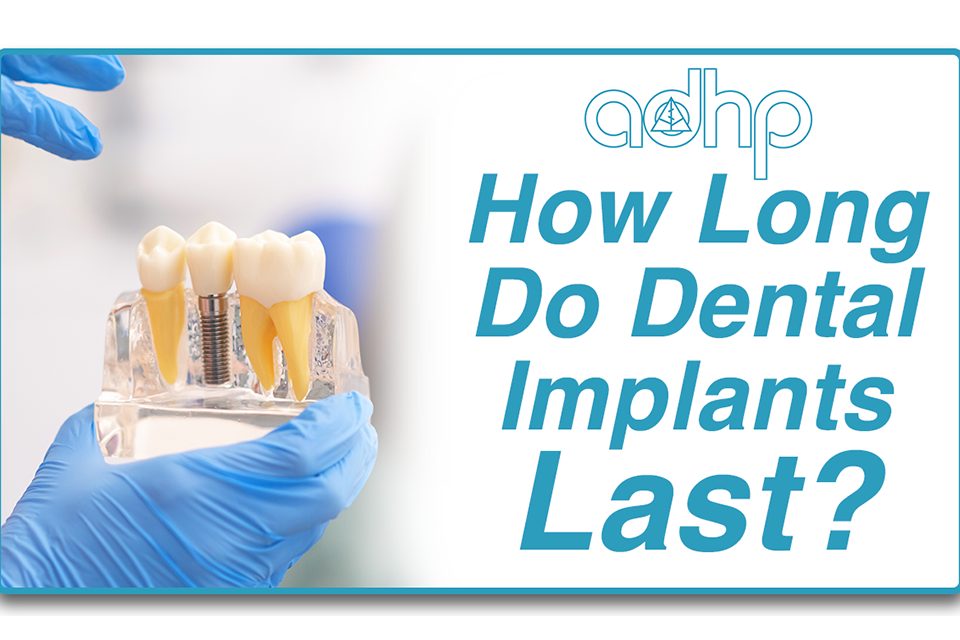 How Long Do Implants Last? adhp fallbrook
