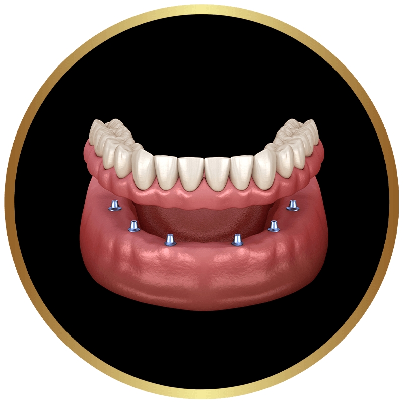 implant