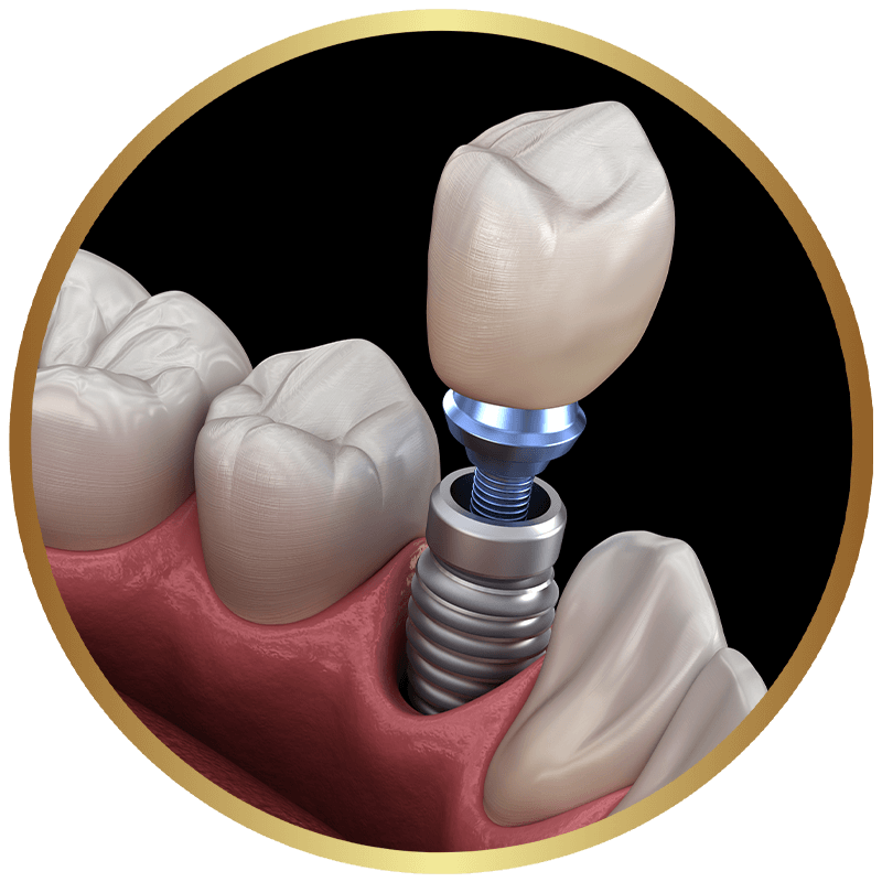 implant single