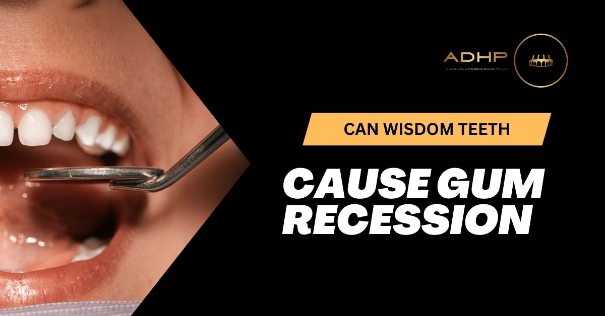 Can Wisdom Teeth Cause Gum Recession? Understanding the Connection