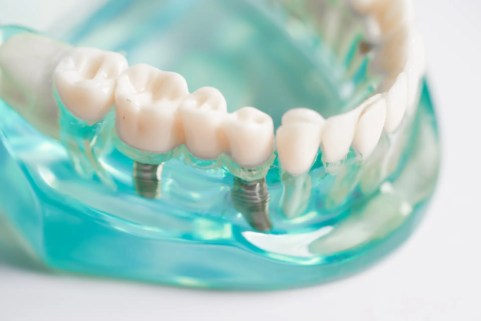 dental-implant-artificial-tooth-roots-into-jaw-torrance-ca