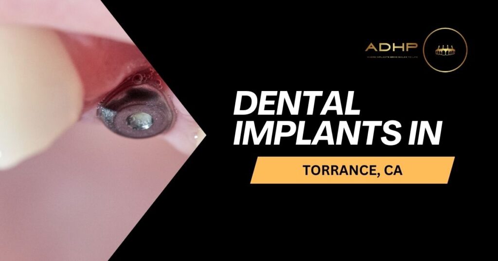 dental-implants-in-torrance-ca american dental health providers