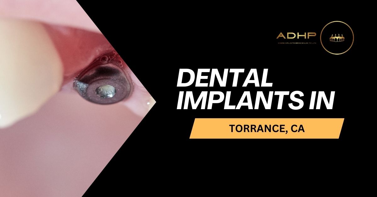 dental-implants-in-torrance-ca american dental health providers