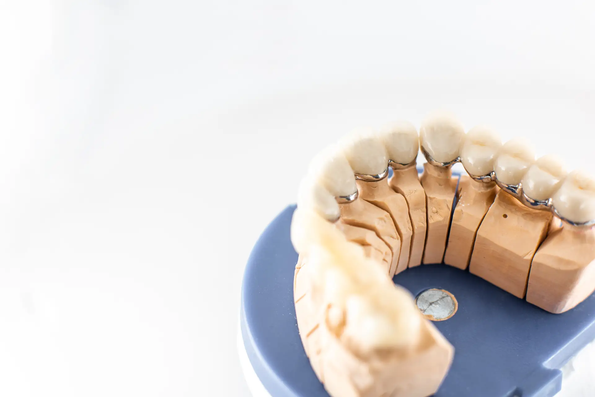dental-imprint-with-artificial-teeth-torrance-california