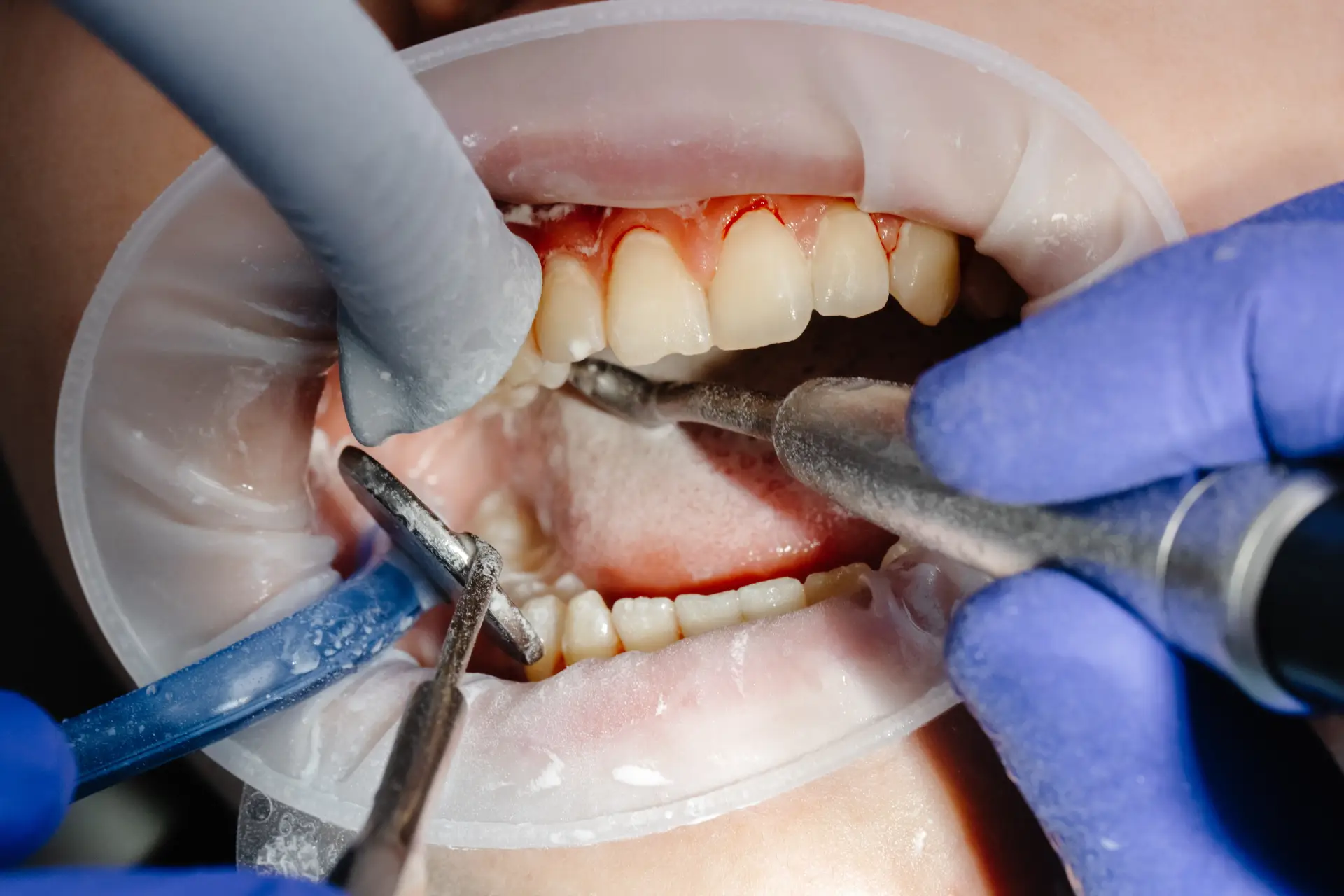 dentist-performing-dental-checkup-cleaning-teeth american dental health providers fallbrook ca