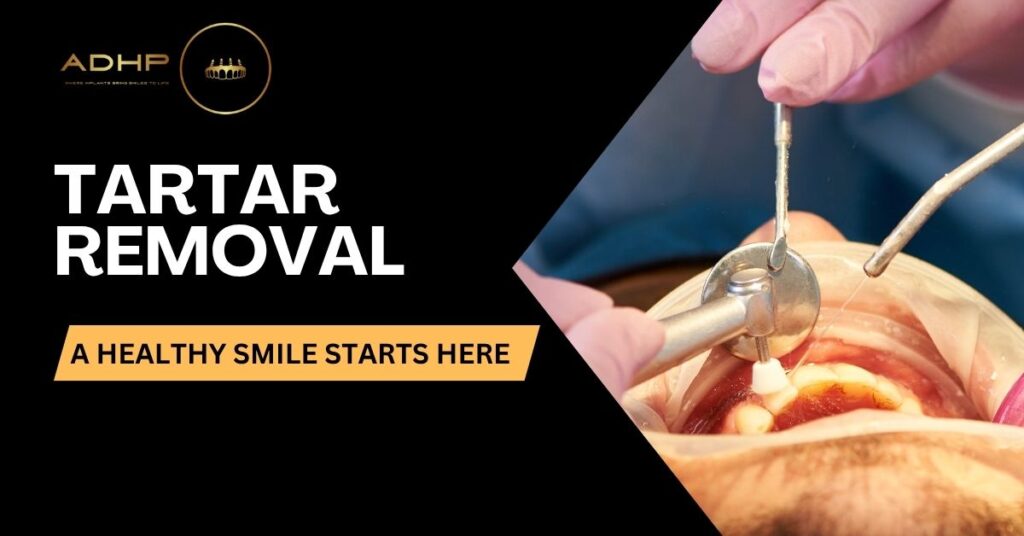 tartar-removal-adhp-ca