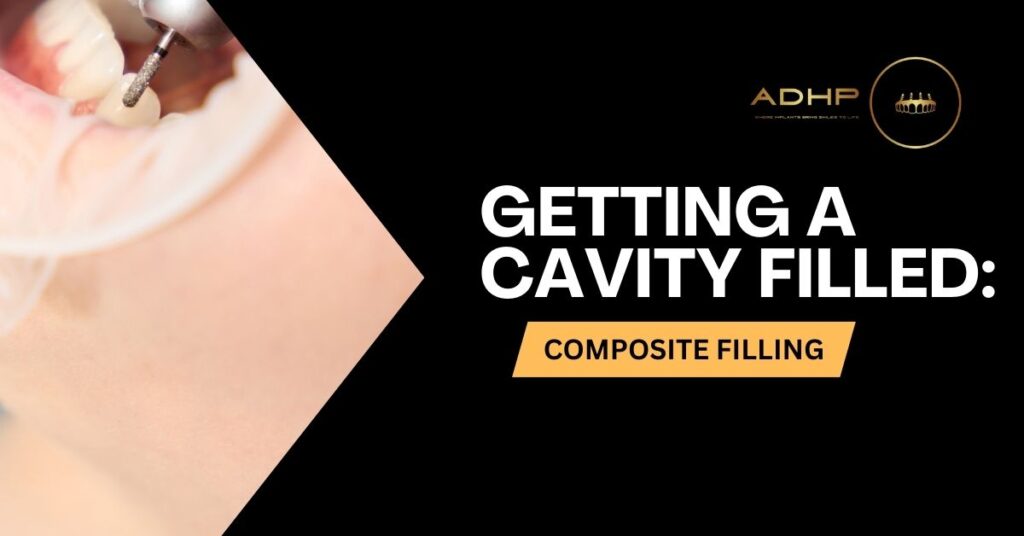 composite-dental-fillings-adhp-ca