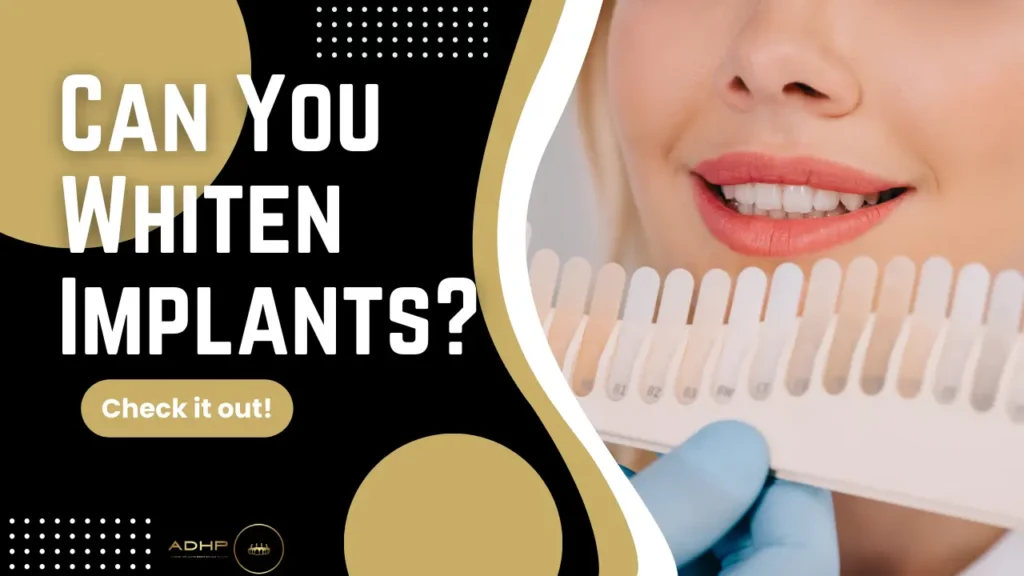 Can You Whiten Implants? Everything Torrance Patients Need to Know