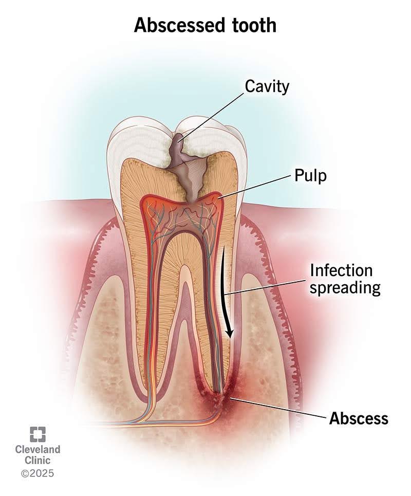 Abscessed Tooth 3