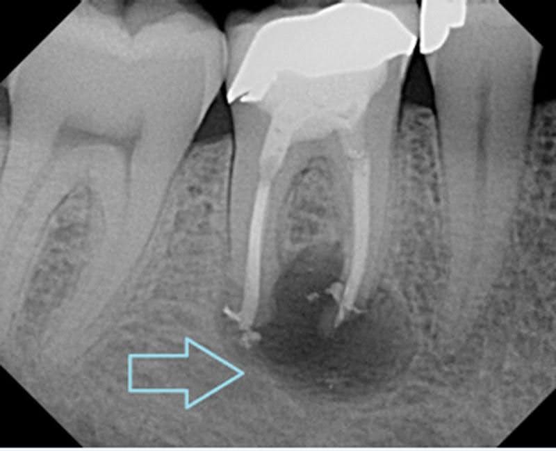 Abscessed Tooth