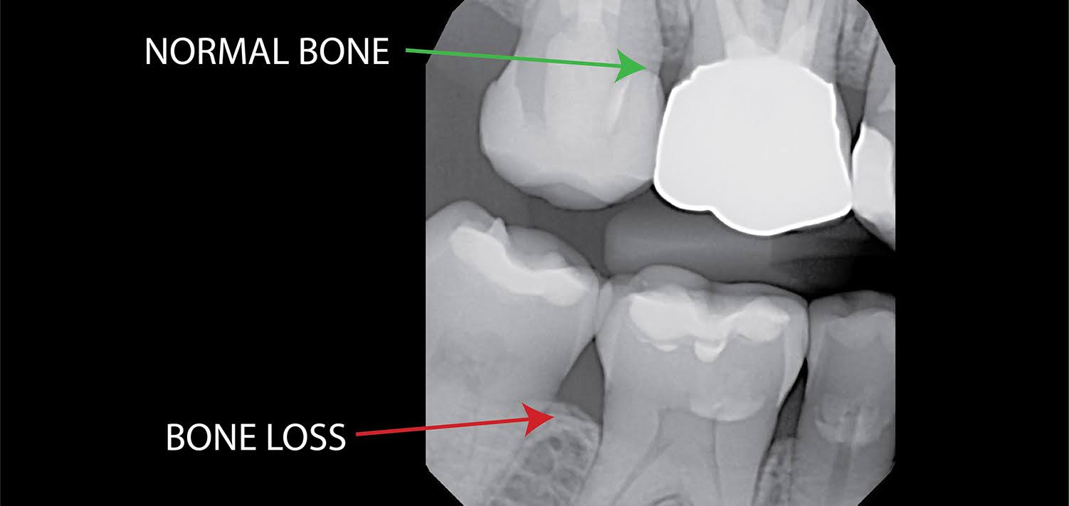 Bone Loss in the Jaw