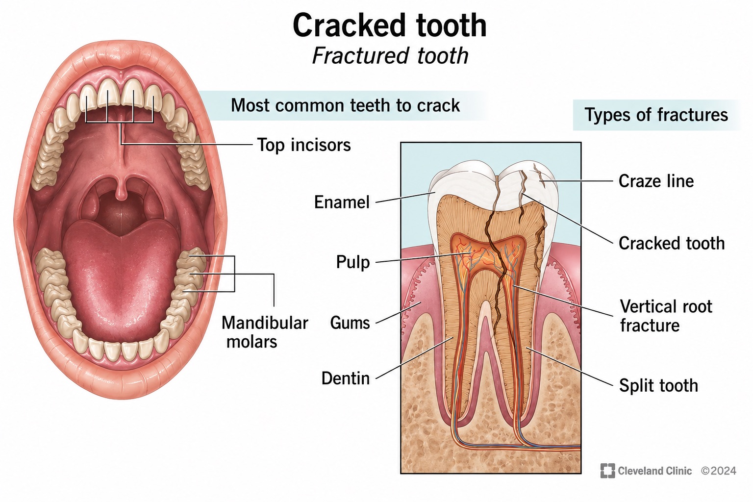 Cracked tooth infographic and fracture guide
