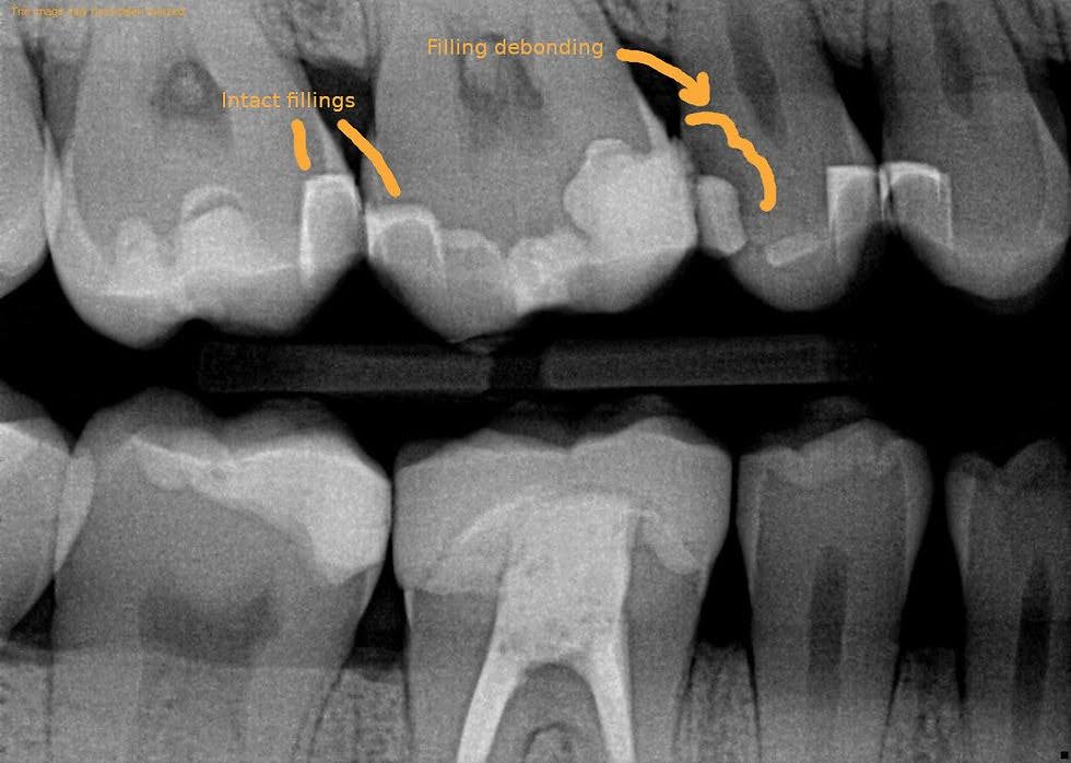 Dental Filling 2
