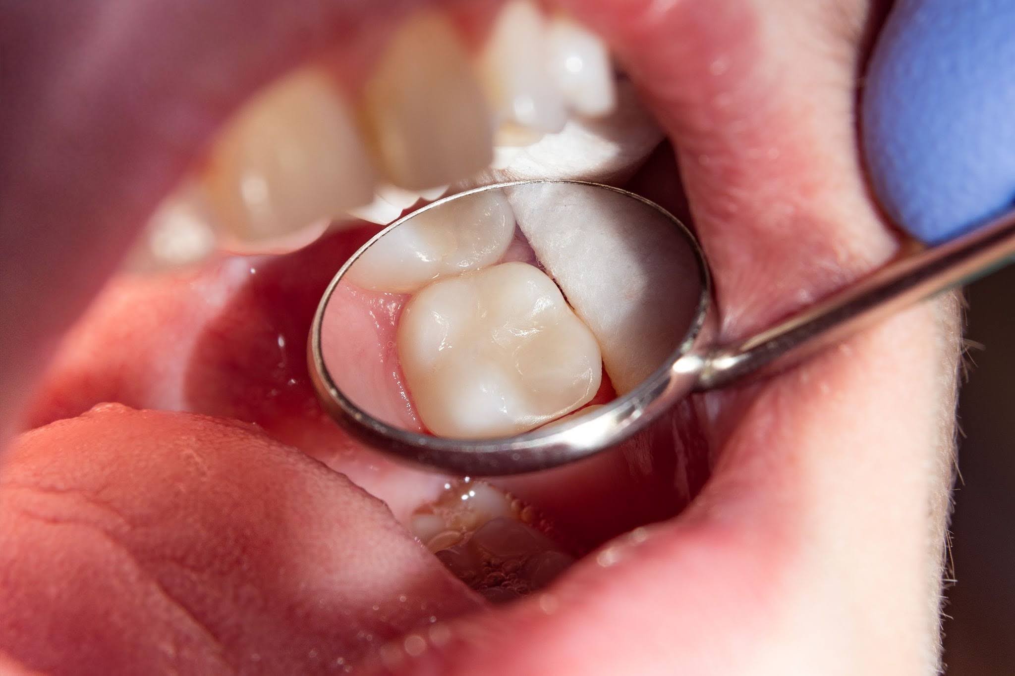 Dental Filling