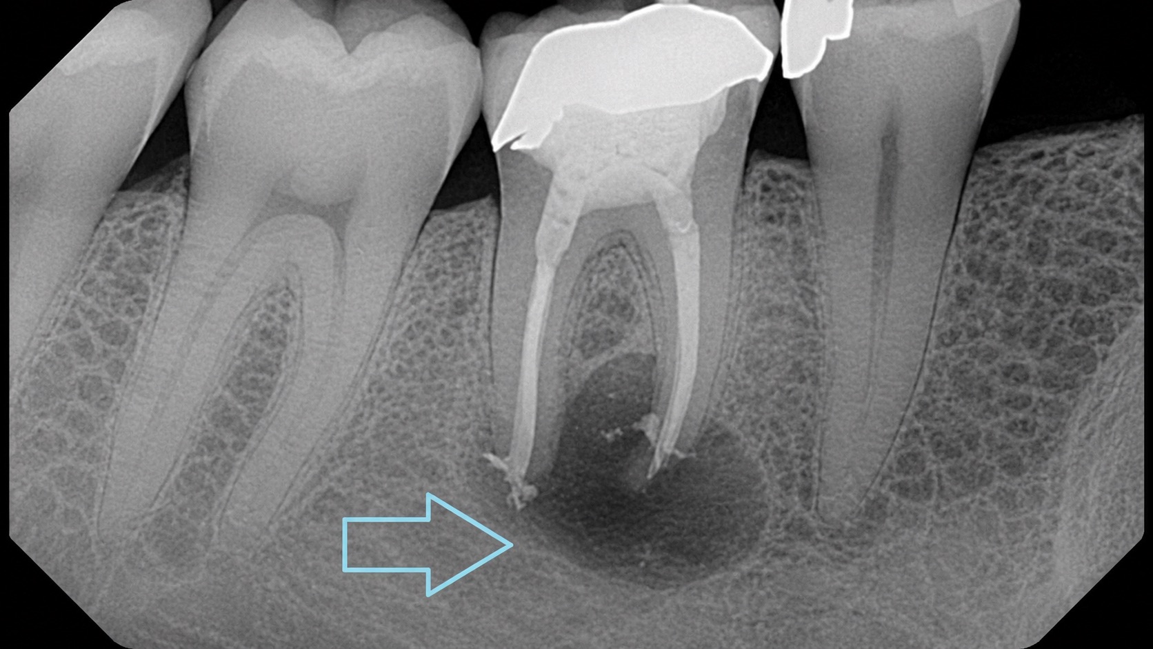 Dental x-ray of treated molar region