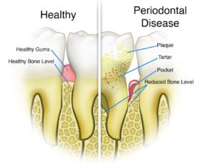 Gum Disease 2