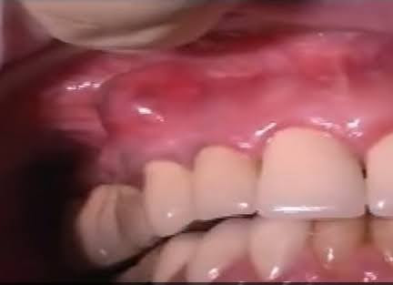 Infection or Abscess