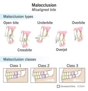 Malocclusion