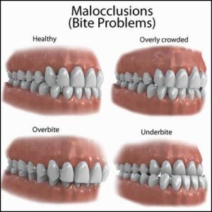 Malocclusion 3