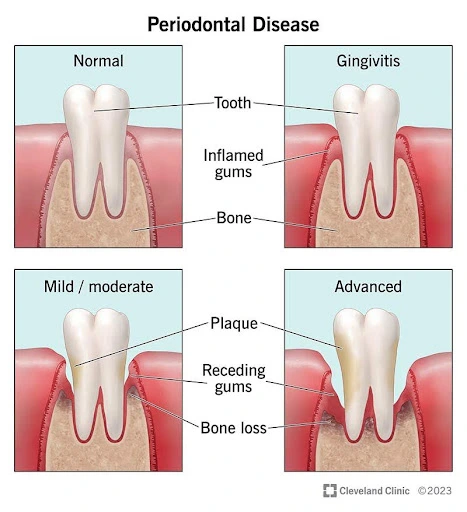 Periodontitis