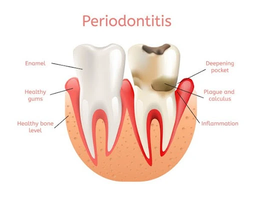 Periodontitis