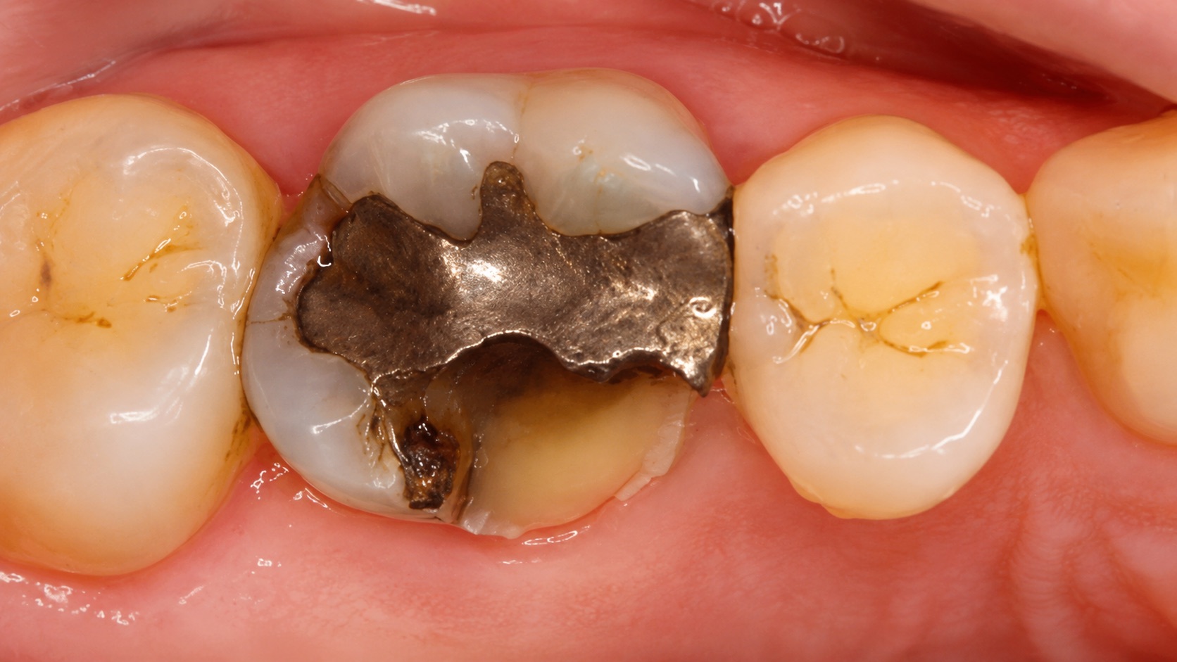 Silver filling in detailed molar teeth