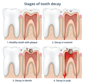 Stages of Tooth Decay 2