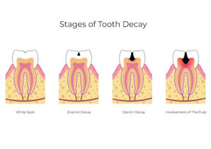 Stages of Tooth Decay