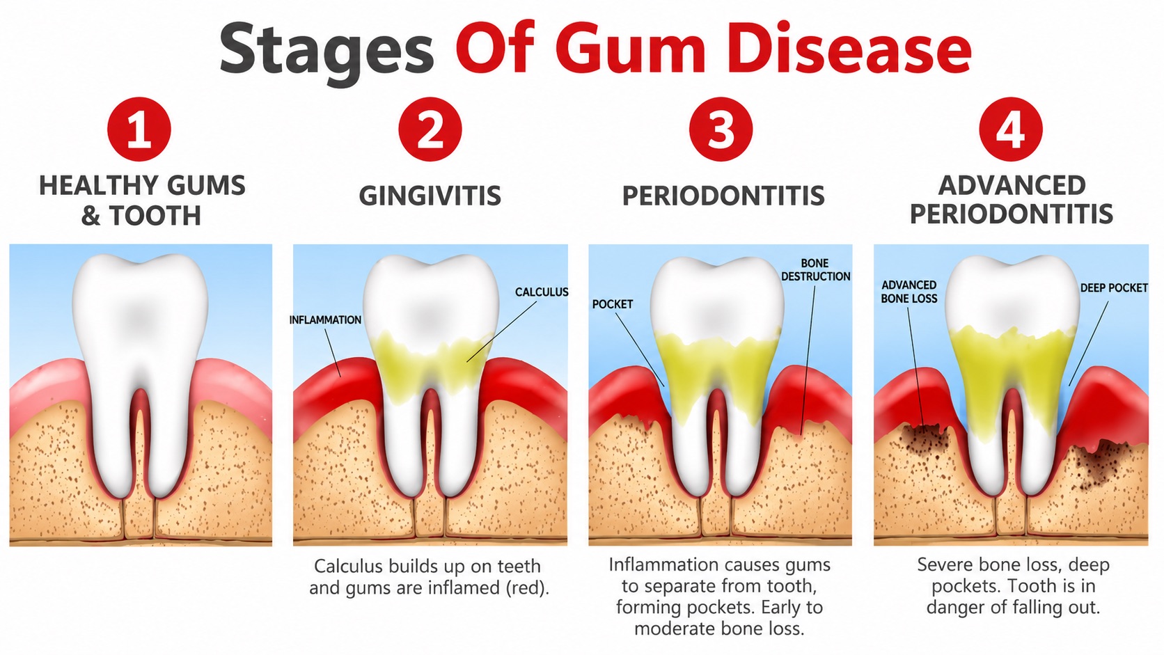 Stages of gum disease infographic