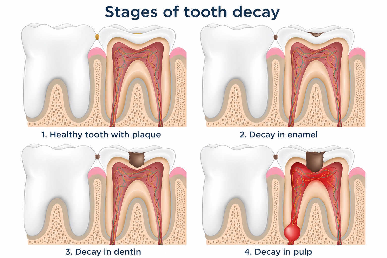 Stages of tooth decay infographic