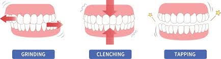 Teeth Grinding (Bruxism)