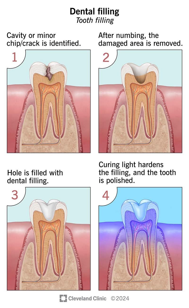 Tooth Filling