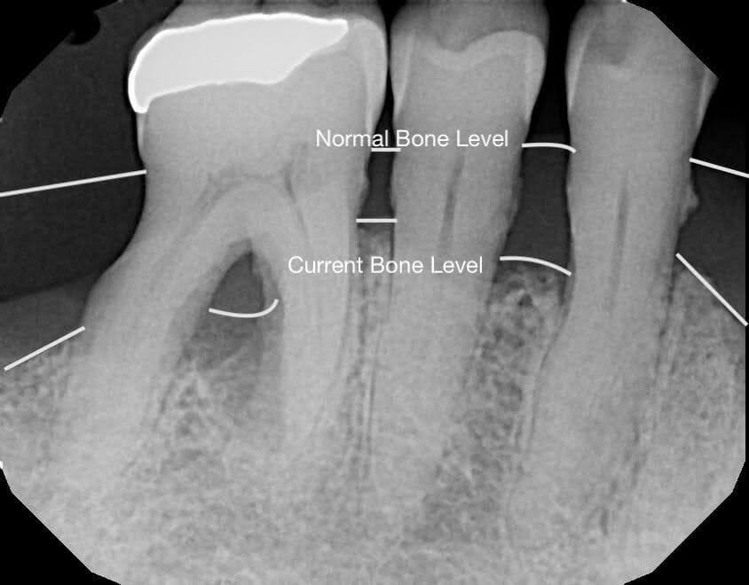 Bone Loss in the Jaw 2