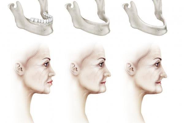 Bone Loss in the Jaw