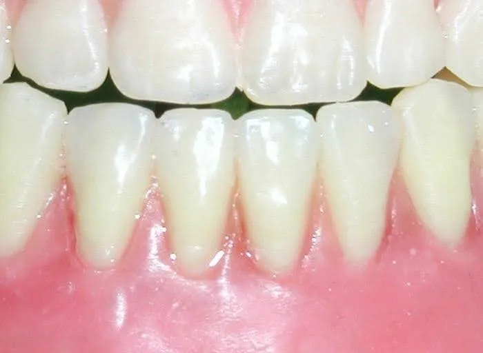 Gum Disease 2