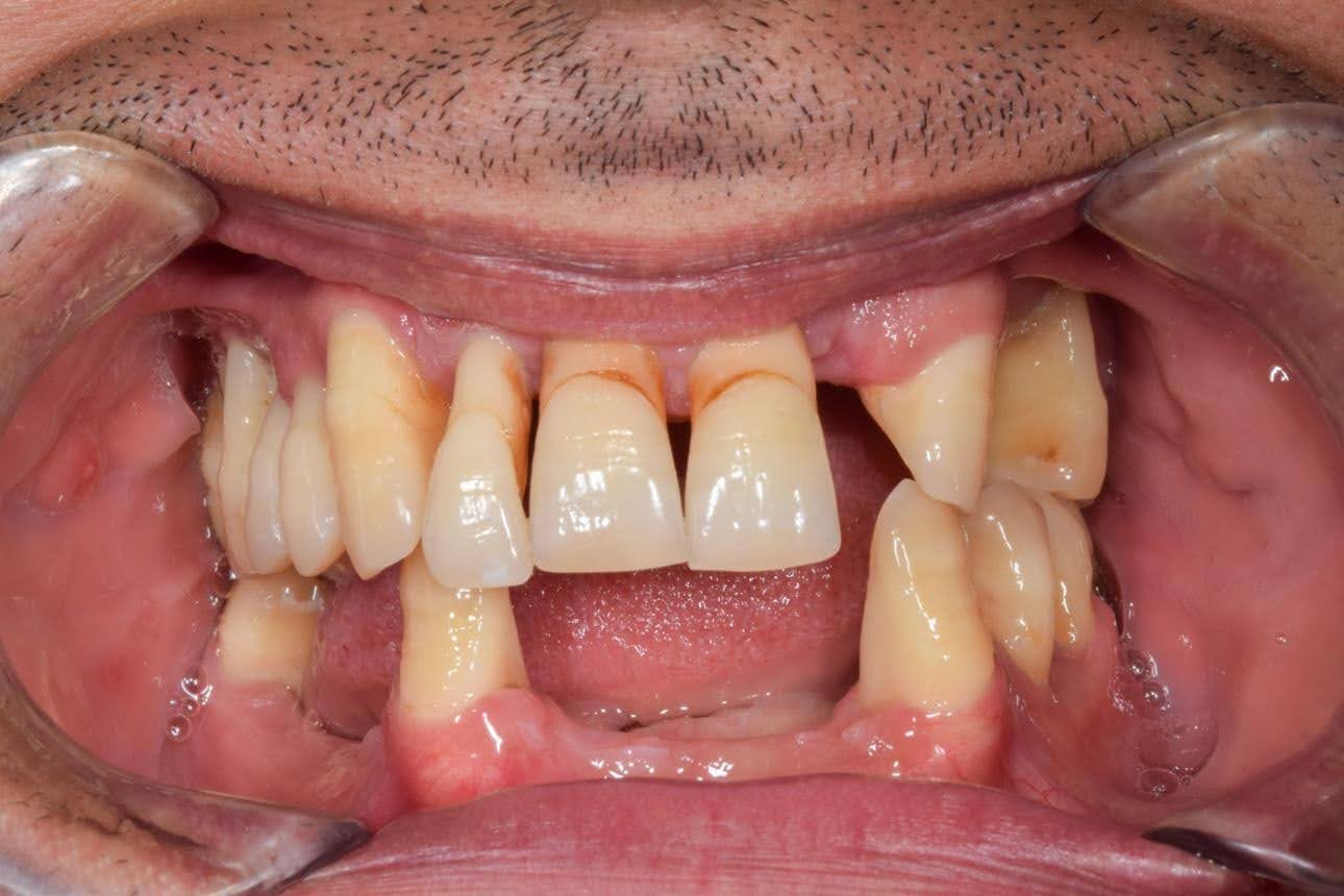 Gum Disease (Periodontal Disease) 2