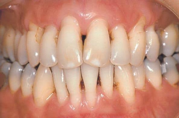 Gum Disease (Periodontal Disease)