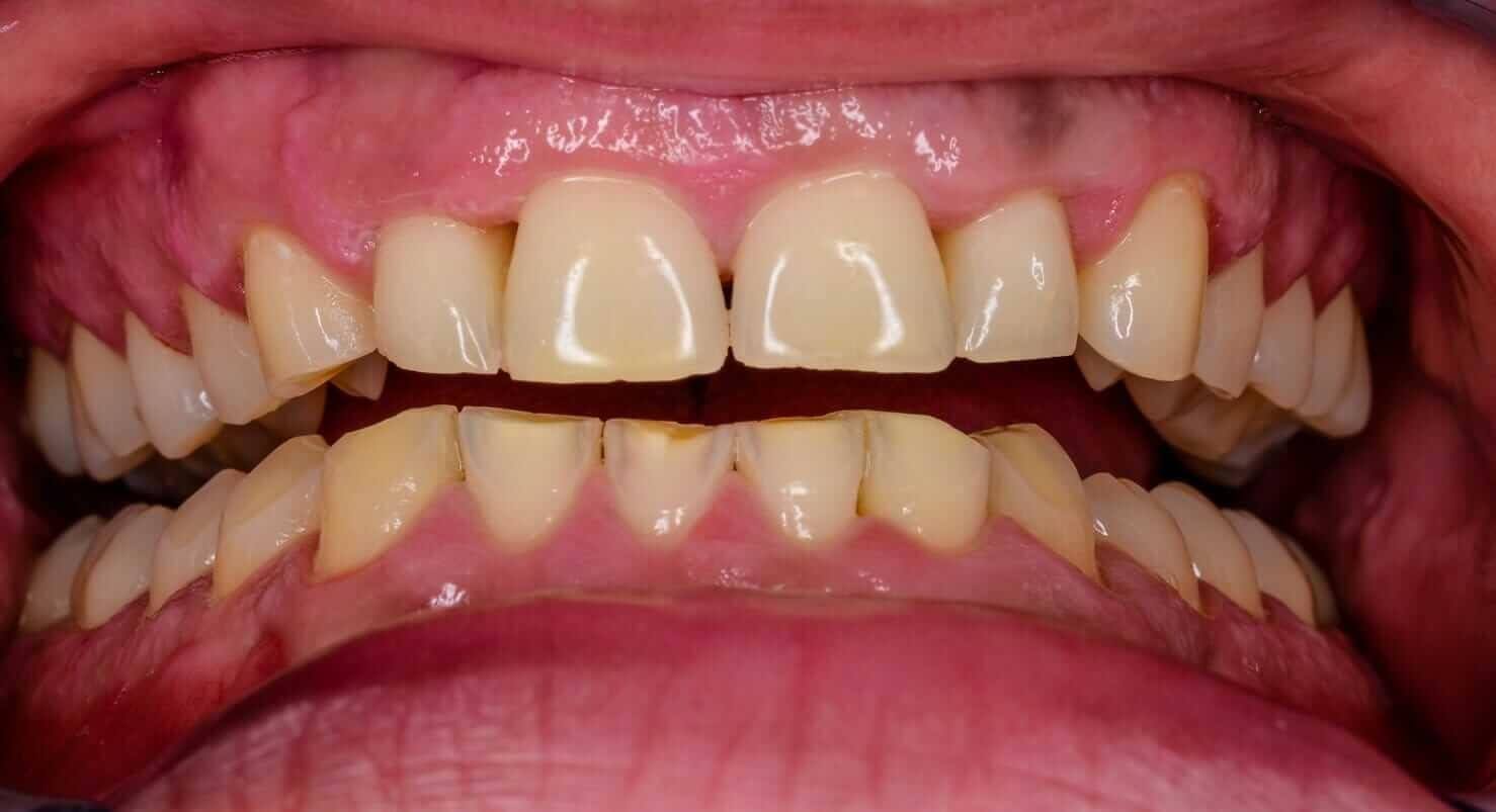 Teeth Grinding (Bruxism) 3