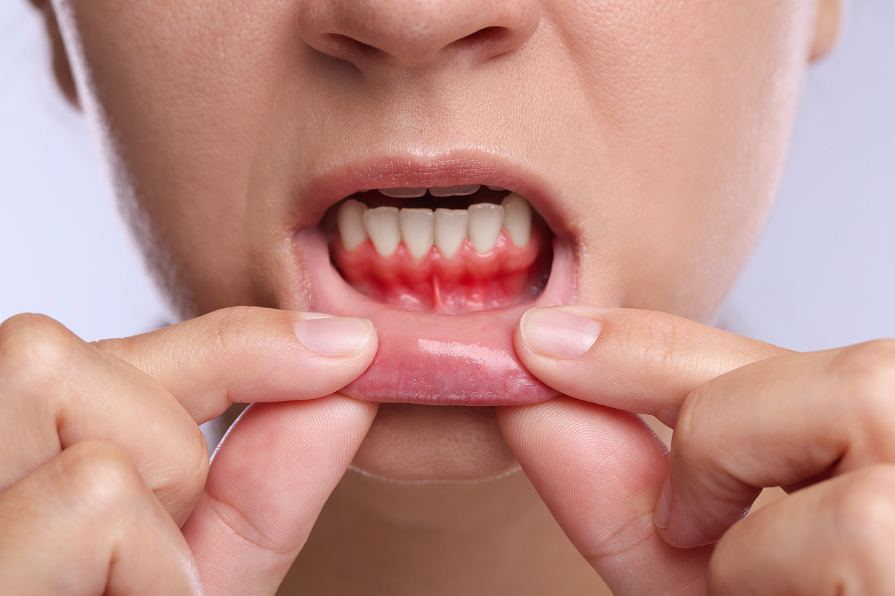 close-up-of-person-showing-red-and-inflamed-gums